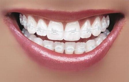 ceramic braces in Dubai