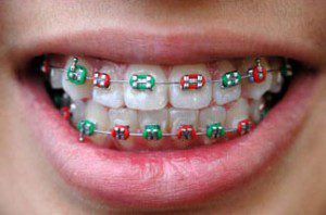 colored metal braces in Dubai