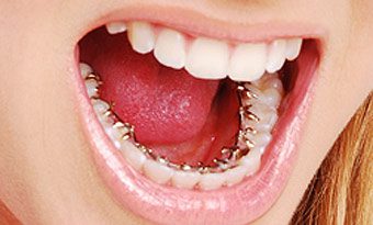 appareil dentaire lingual incognito à Dubaï