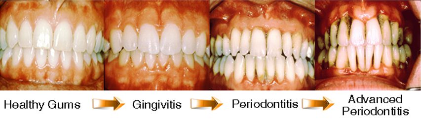 Gingivitis Parodontitis