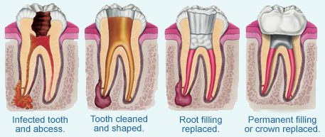 Root canal treatment Dubai UAE