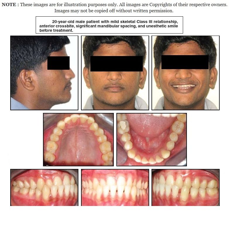 قبل العلاج