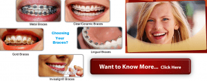 Choosing the cheap and best braces for you