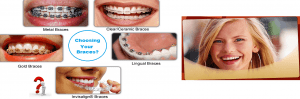 braces in Dubai UAE