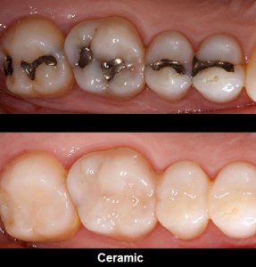 dental filling dubai UAE
