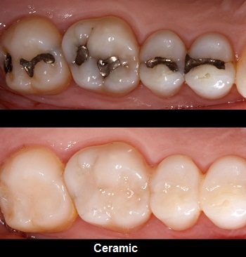 Costo de los empastes dentales en Dubai