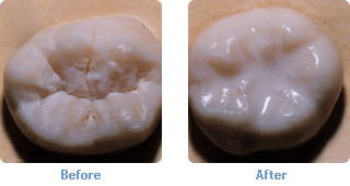 стоматологические герметики