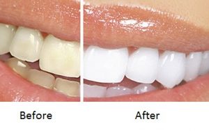 laser teeth whitening Dubai results before and after