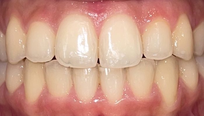 Invisalign Dubai