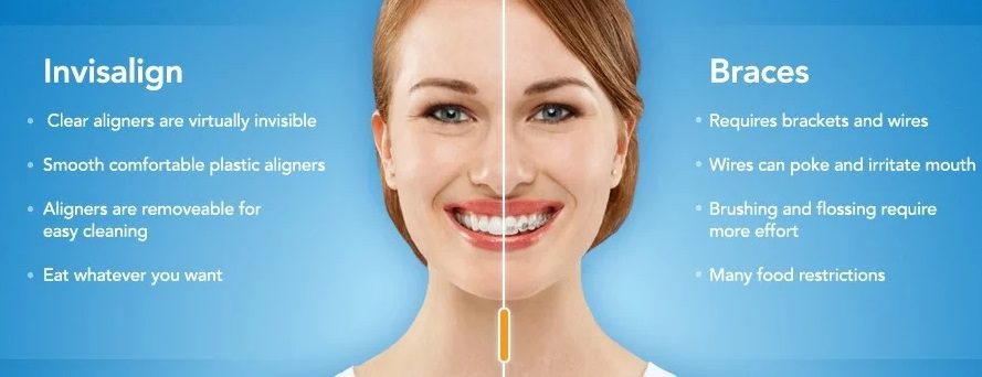 Unterschied zwischen Invisalign und Zahnspange