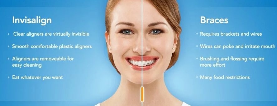 Разница между Invisalign и брекетами