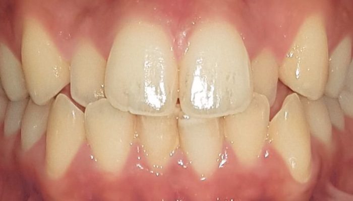Invisalign in Dubai