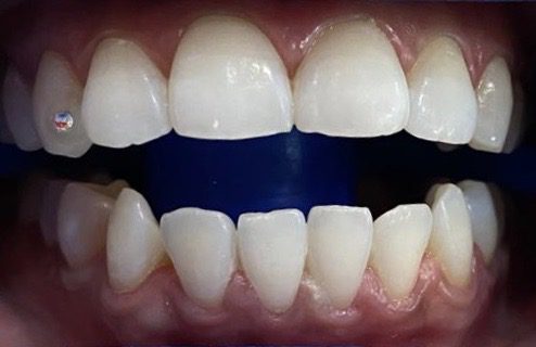 Blanqueamiento Dental Dubái
