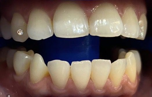 Blanqueamiento dental en Dubái