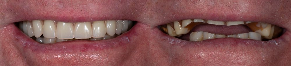 Implant dentaire Dubaï photo