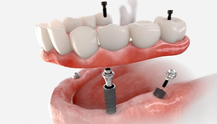 Hepsi 4 diş implantında