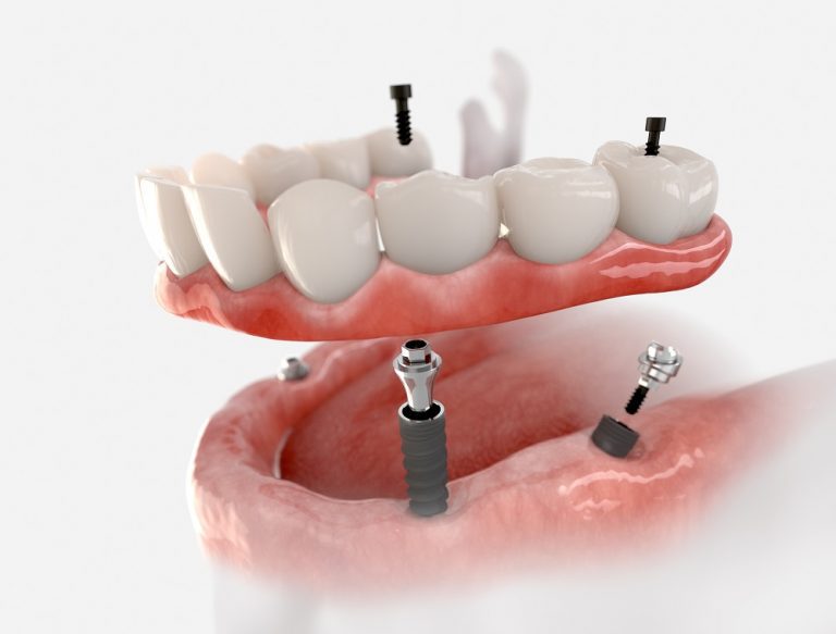 Dental implants in Dubai Dental implants cost in Dubai