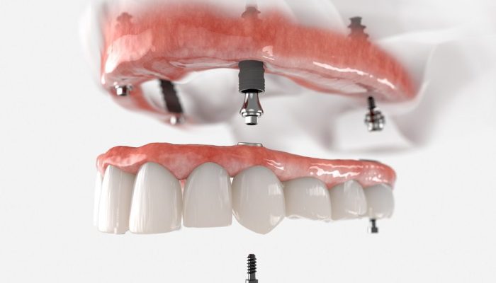 Le tout sur 4 implants dentaires