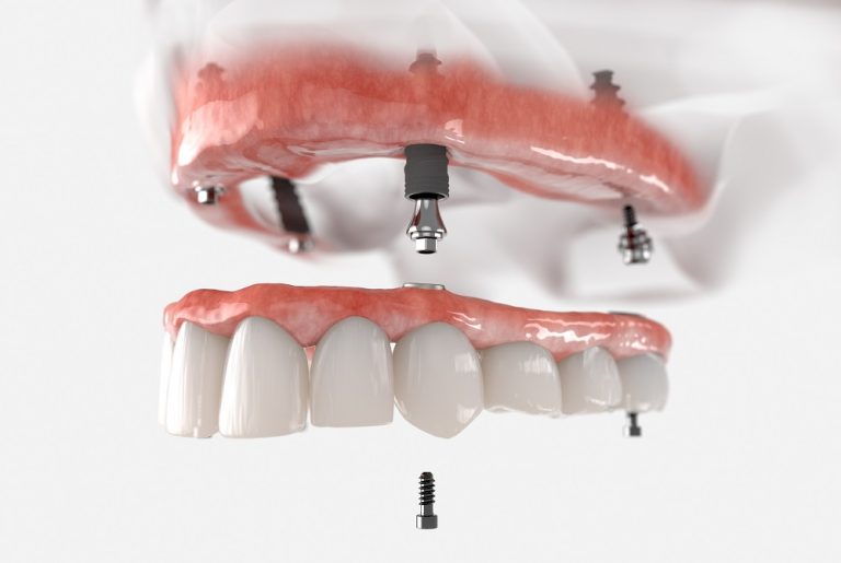 Dental implants in Dubai Dental implants cost in Dubai