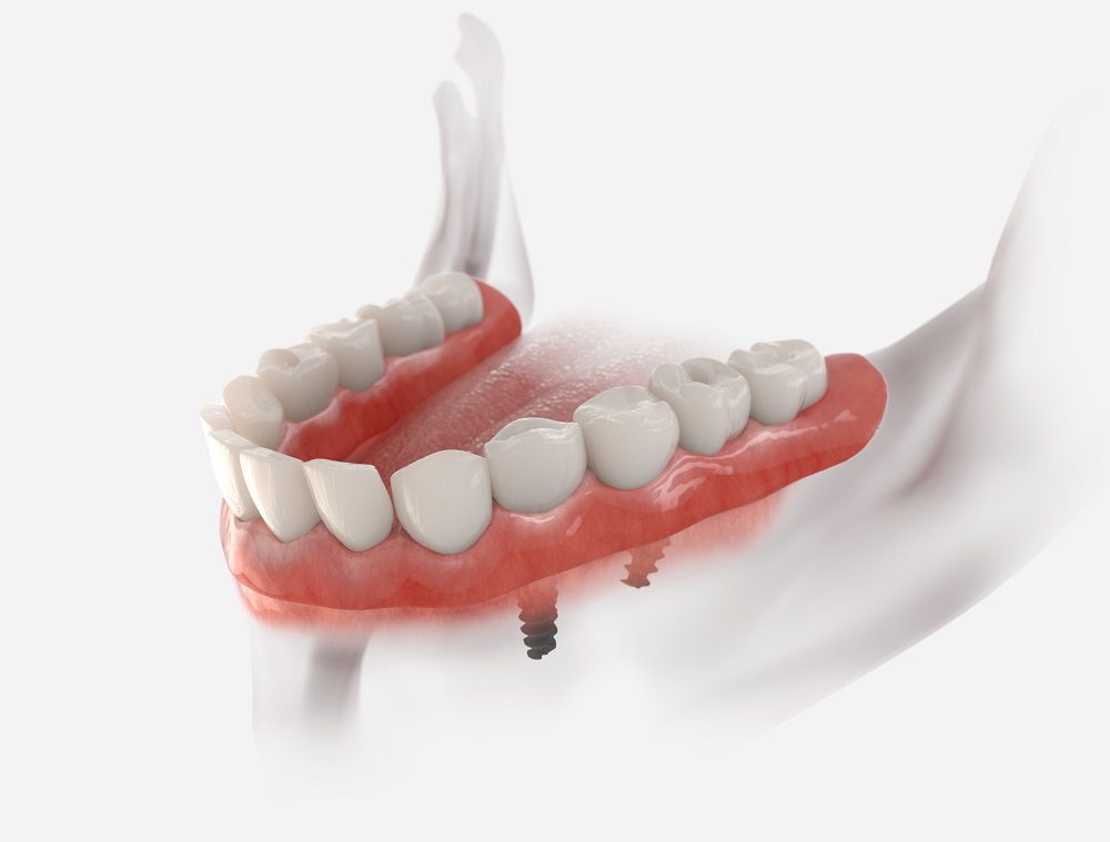 Dental implants in Dubai Dental implants cost in Dubai