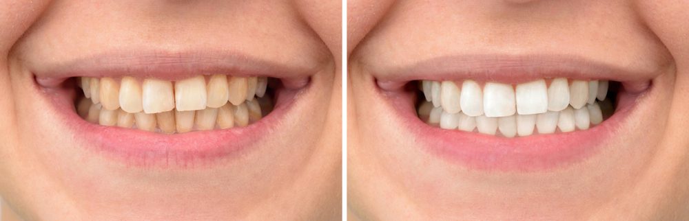 Blanqueamiento dental Dubái pics