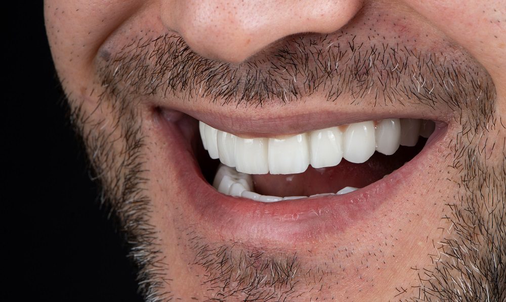 Los implantes dentales cuestan Dubai