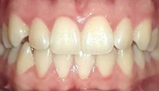Kosten für Invisalign