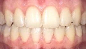 Invisalign kosten dubai