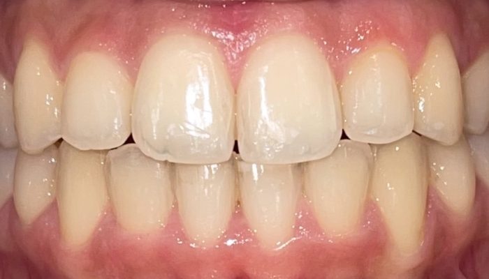 Tooth braces