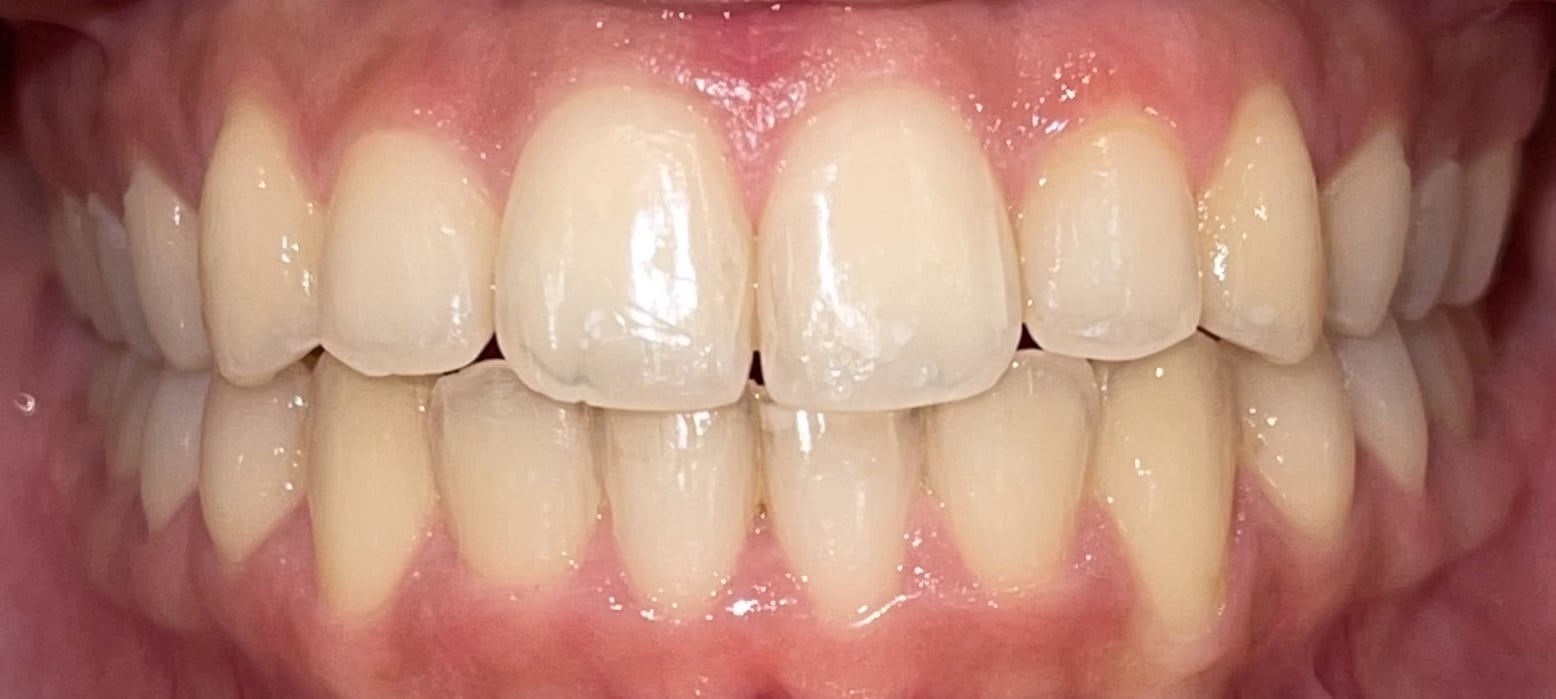 Braces in Dubai Teeth Braces Orthodontist Dubai UAE