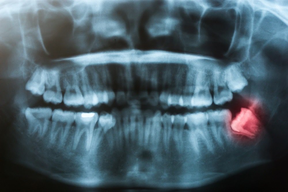 Extraction des dents de sagesse Dubaï