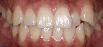 brackets metalicos antes