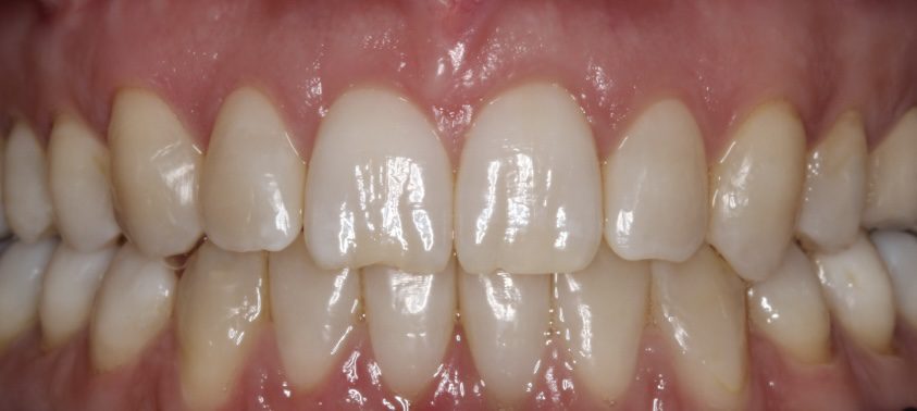 mejor ortodoncista dubai post tratamiento
