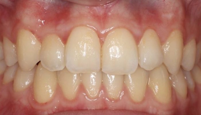 braces dubai after pic