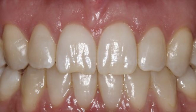 braces dubai post treatment