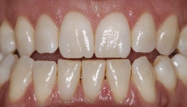 braces dubai pre treatment