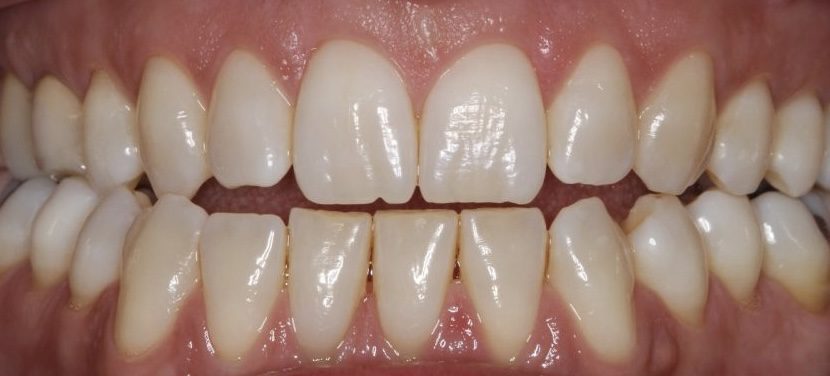علاج ما قبل تقويم الاسنان في دبي