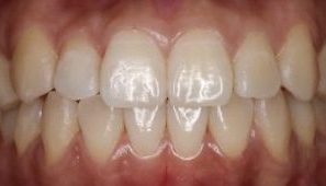 braces in dubai after