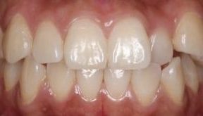 braces in dubai before