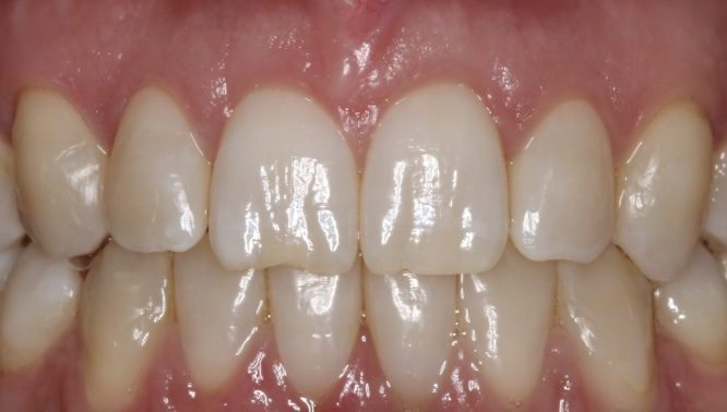 eon aligners voltooide afbeelding