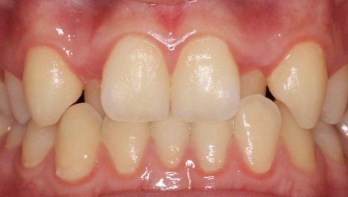 eon aligners pre treatment