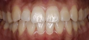 Invisalign Dubai Nachbehandlung
