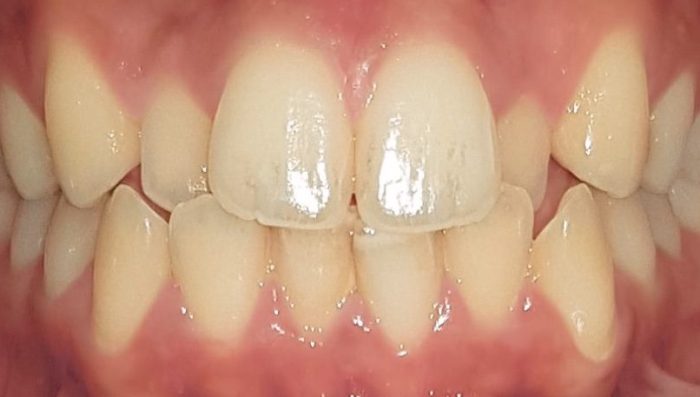 eon aligners before picture