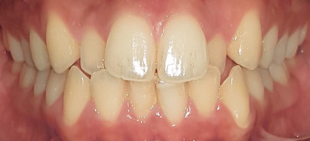 imagen del paciente con brackets metálicos