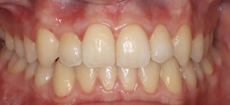 post tratamiento con brackets metálicos