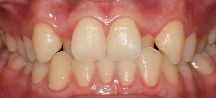 pretratamiento con brackets metalicos