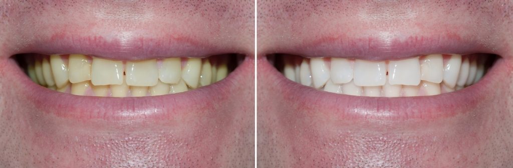 blanqueamiento dental dubai post tratamiento