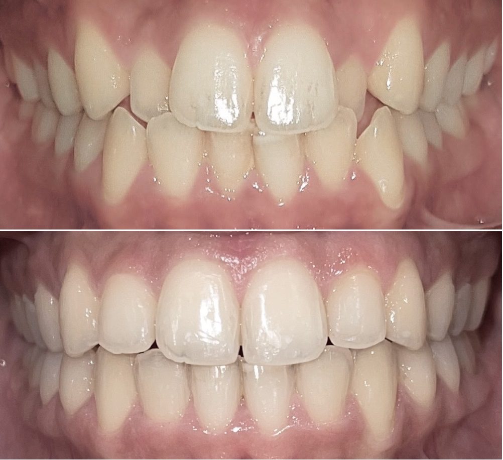 علاج تقويم الأسنان قبل وبعد الصورة 3