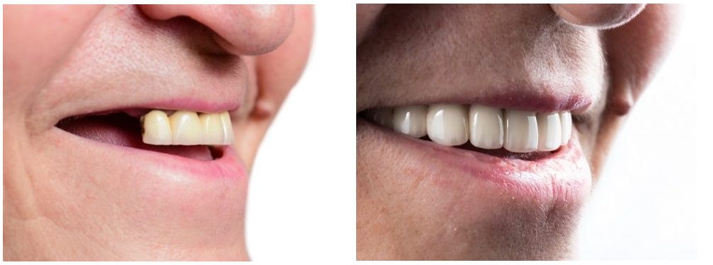 Zahnimplantate vor und nach Bild 2