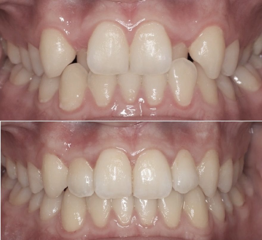 braces treatment in dubai before and after picture 4